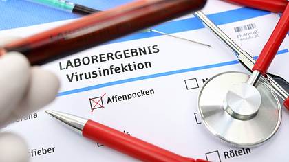 Laborformular zum Affenpocken-Virus - Foto: IMAGO/Christian Ohde