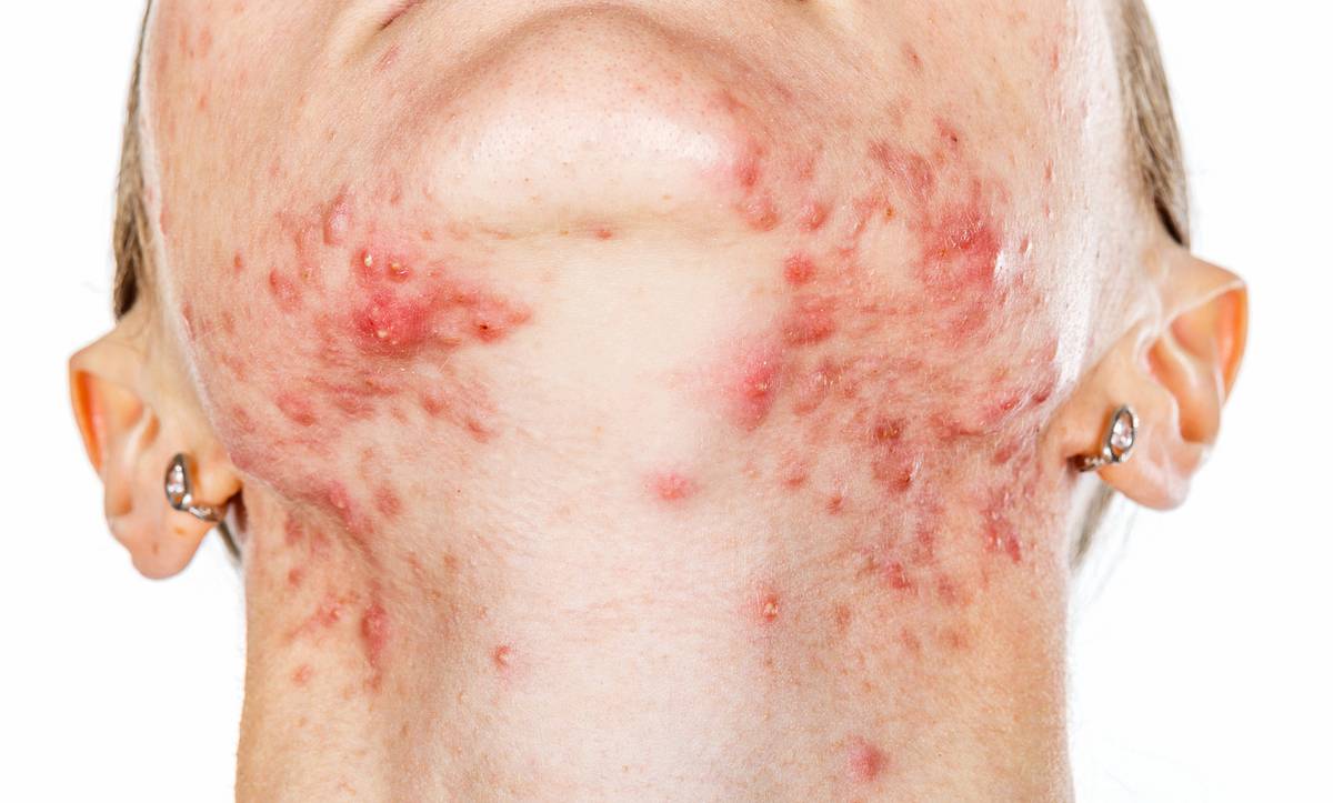 Akne belastet seelische die Betroffenen und beeinträchtigt deren Selbstwertgefühl