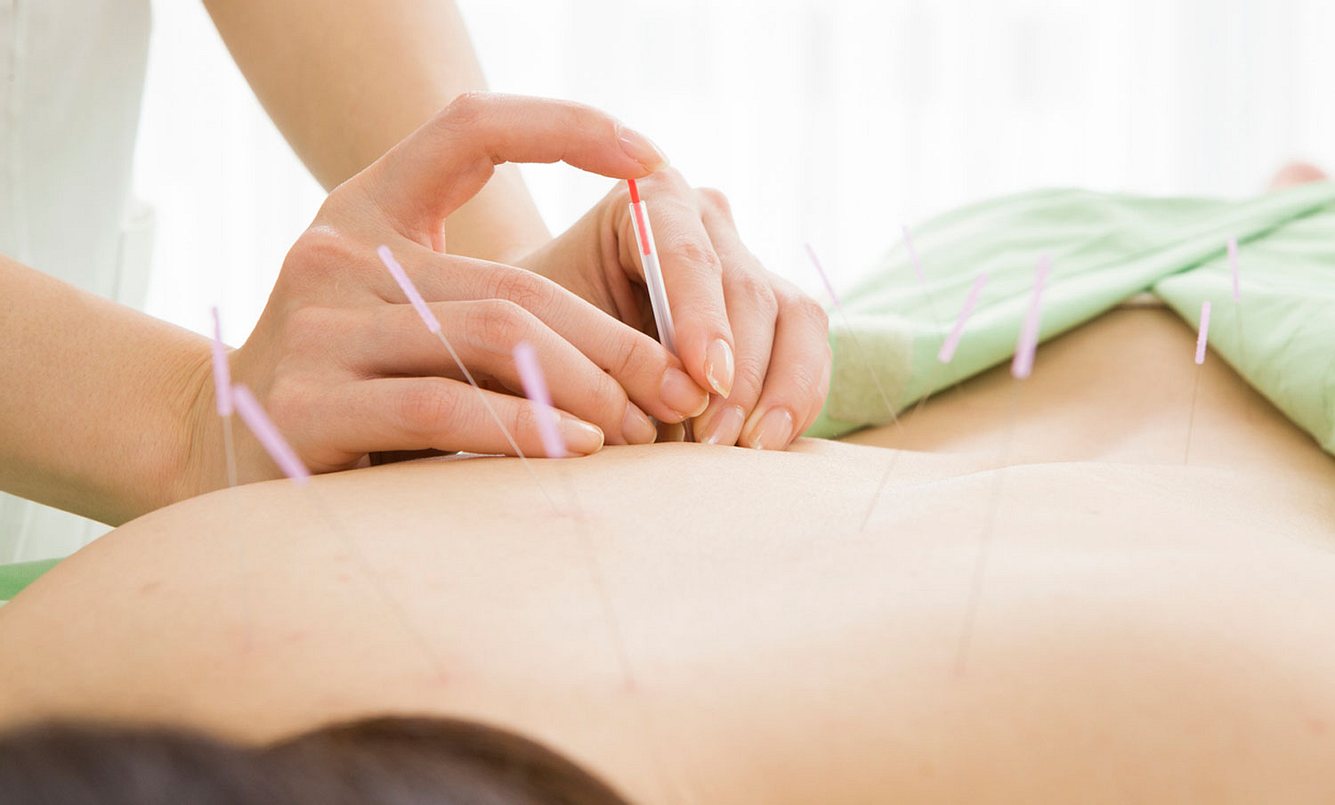 Eine Frau bekommt Akupunkturnadeln in den Rücken gesetzt