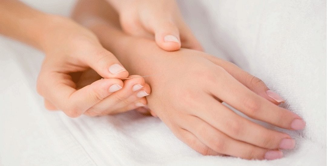 Akupunktur der Hand