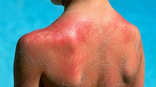Junge mit Sonnenbrand auf dem Rücken - Foto: Alamy
