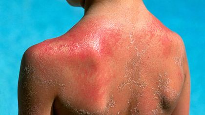 Junge mit Sonnenbrand auf dem Rücken - Foto: Alamy