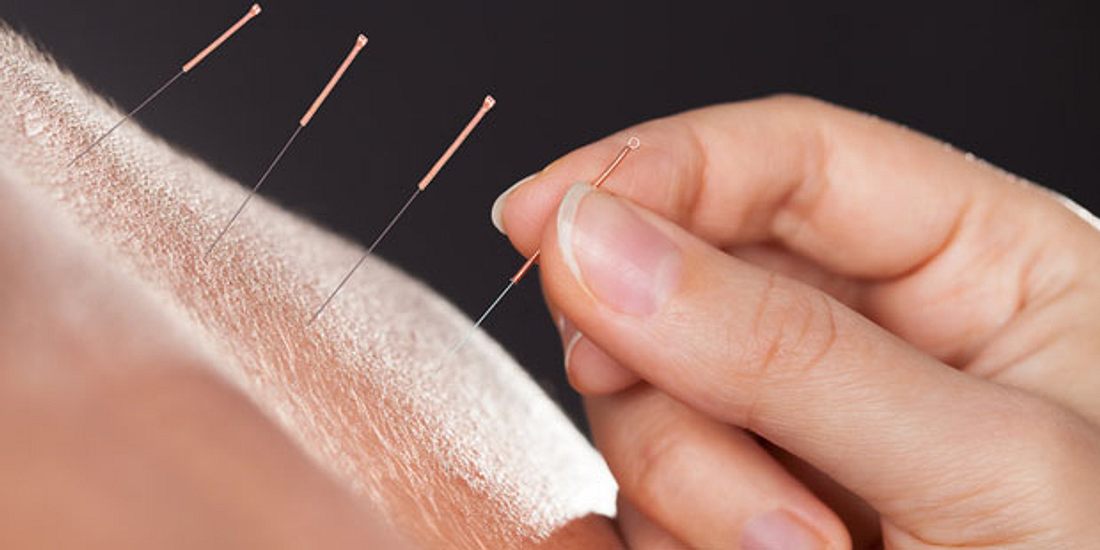 Heuschnupfen und Akupunktur