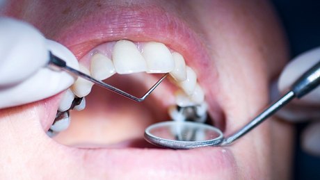 Patient beim Zahnarzt mit Amalgamfüllung - Foto: iStock/garysludden