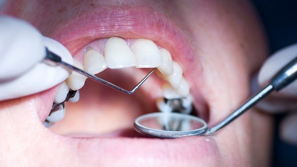 Patient beim Zahnarzt mit Amalgamfüllung - Foto: iStock/garysludden