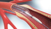 3D-Darstellung eines Implantats zur Unterstützung der Durchblutung der Blutgefäße. - Foto: iStock / Christoph Burgstedt