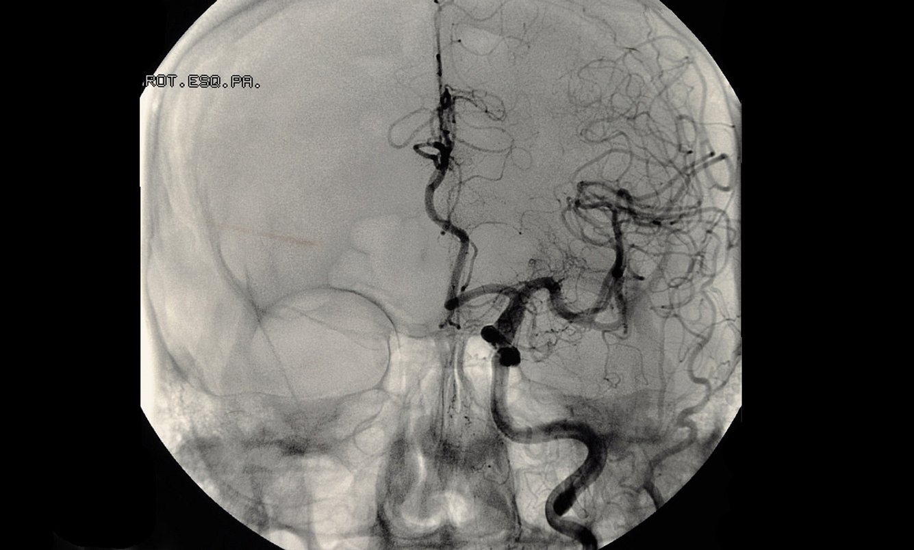 Um ein Aneurysma im Kopf zu diagnostizieren wird eine MR-Arteriographie veranlasst
