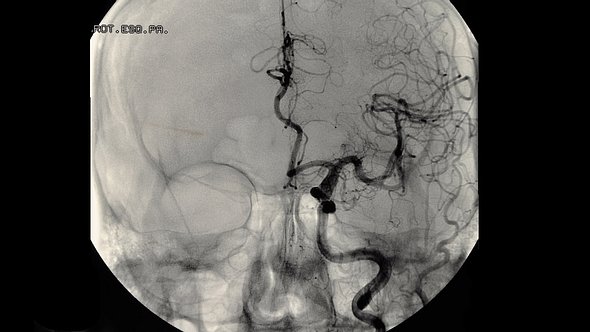 Um ein Aneurysma im Kopf zu diagnostizieren wird eine MR-Arteriographie veranlasst - Foto: iStock/wenht