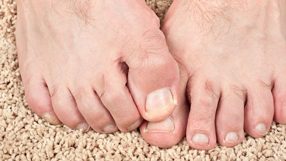 Was hilft gegen Fußpilz? – 3 Experten antworten