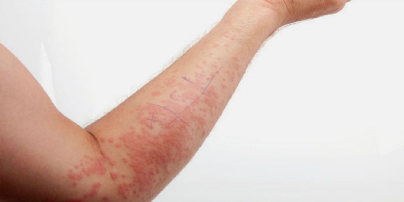 Der allergische Hautausschlag zeigt sich nach wiederholtem Kontakt mit dem Allergieauslöser