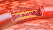 Querschnitt einer verkalkten Arterie.  - Foto: iStock/CreVis2