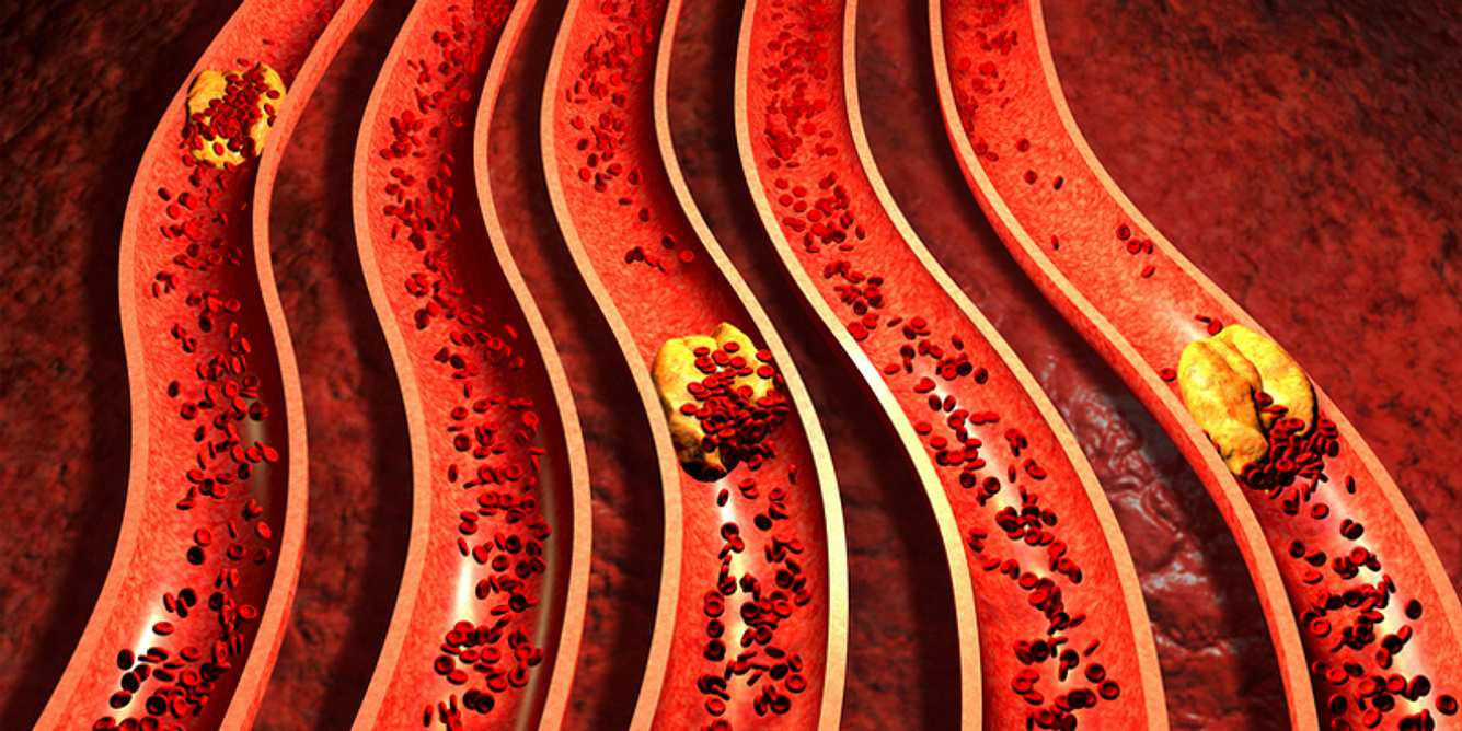 Vaskuläre Demenz durch Arteriosklerose