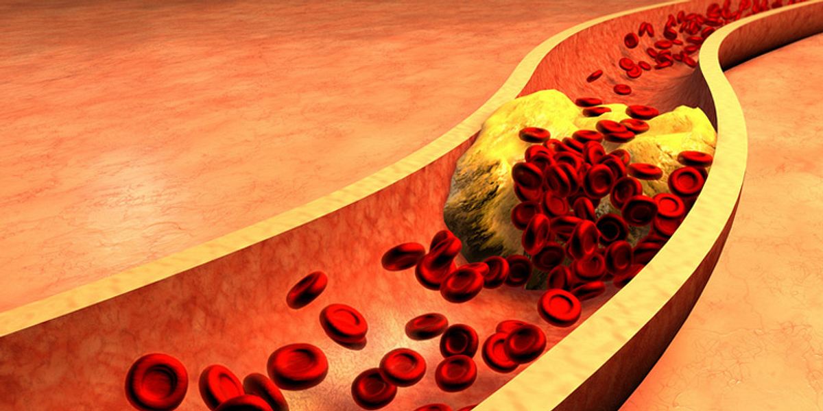 Erhöhtes Schlaganfall-Risiko durch Arteriosklerose