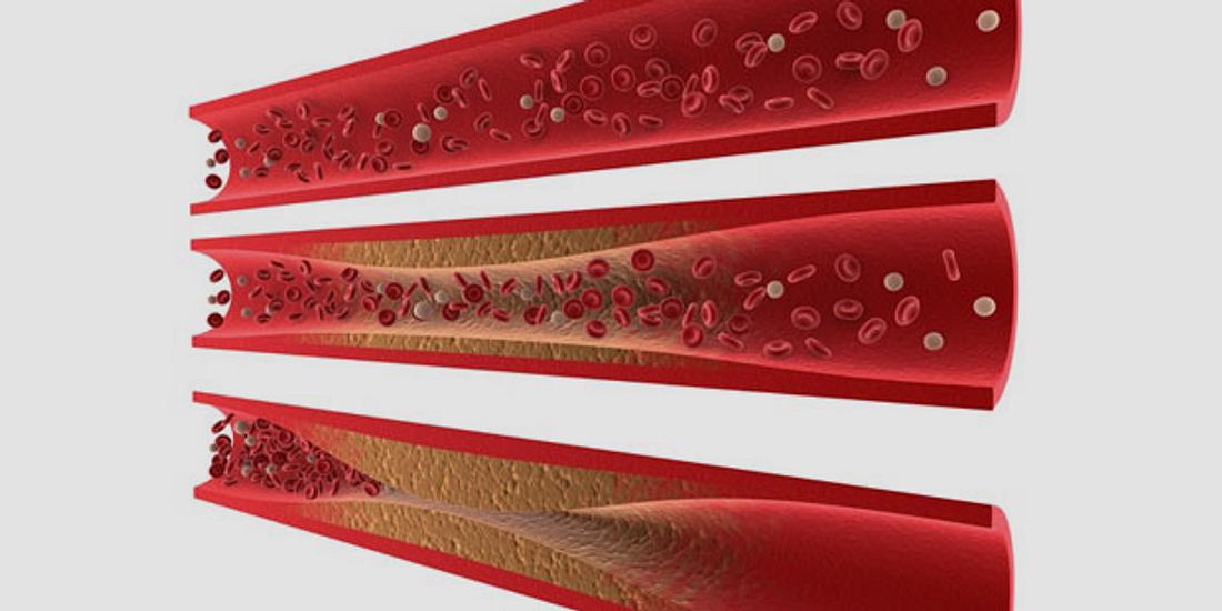 Arteriosklerose als Begleiterscheinung von Rheuma