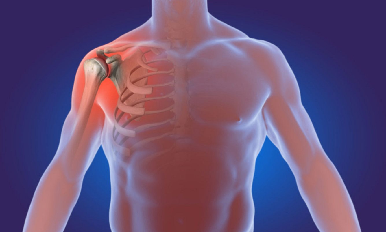Arthrose in der Schulter