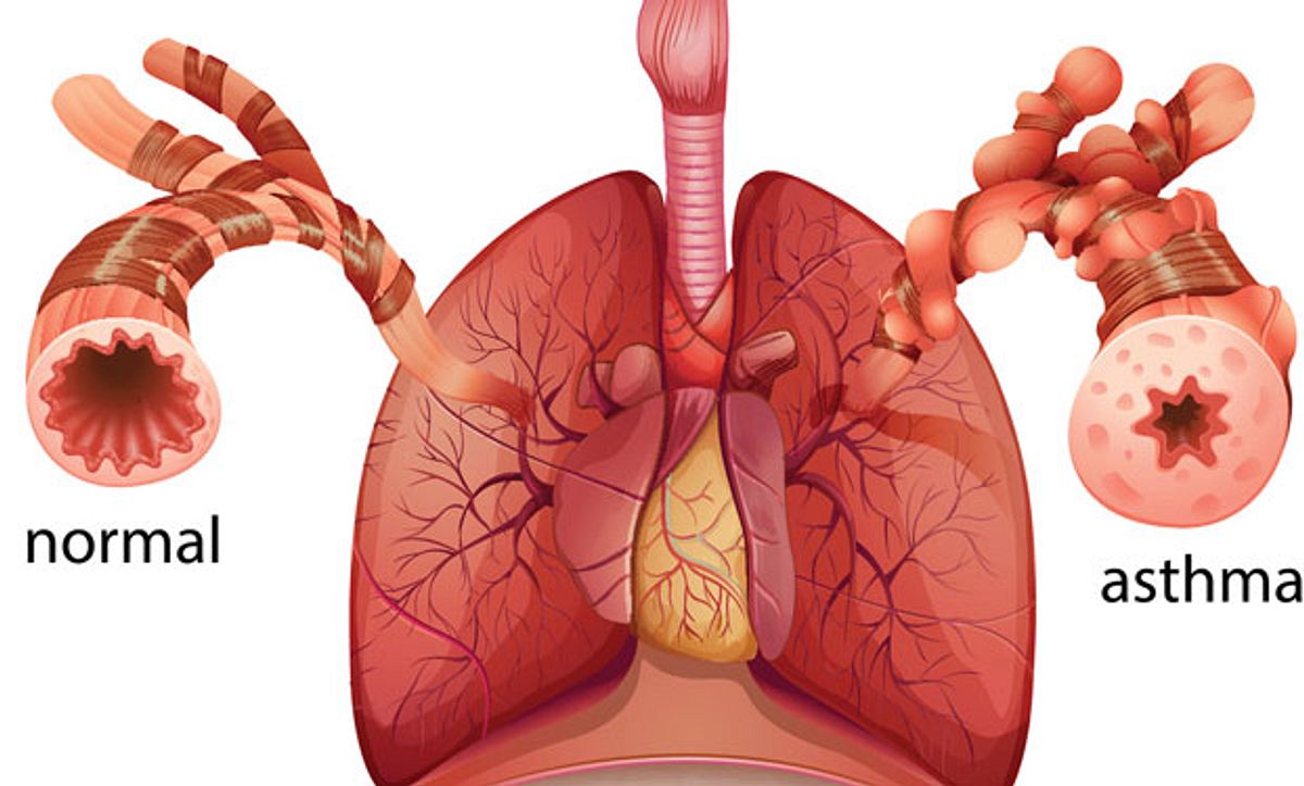 Grafik Lunge normal und mit Asthma
