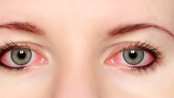 Augenherpes – welche Therapien setzt der Augenarzt ein?