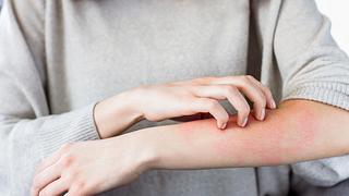 Frau mit Ausschlag am Arm kratzt sich - Foto: iStock/monstArrr