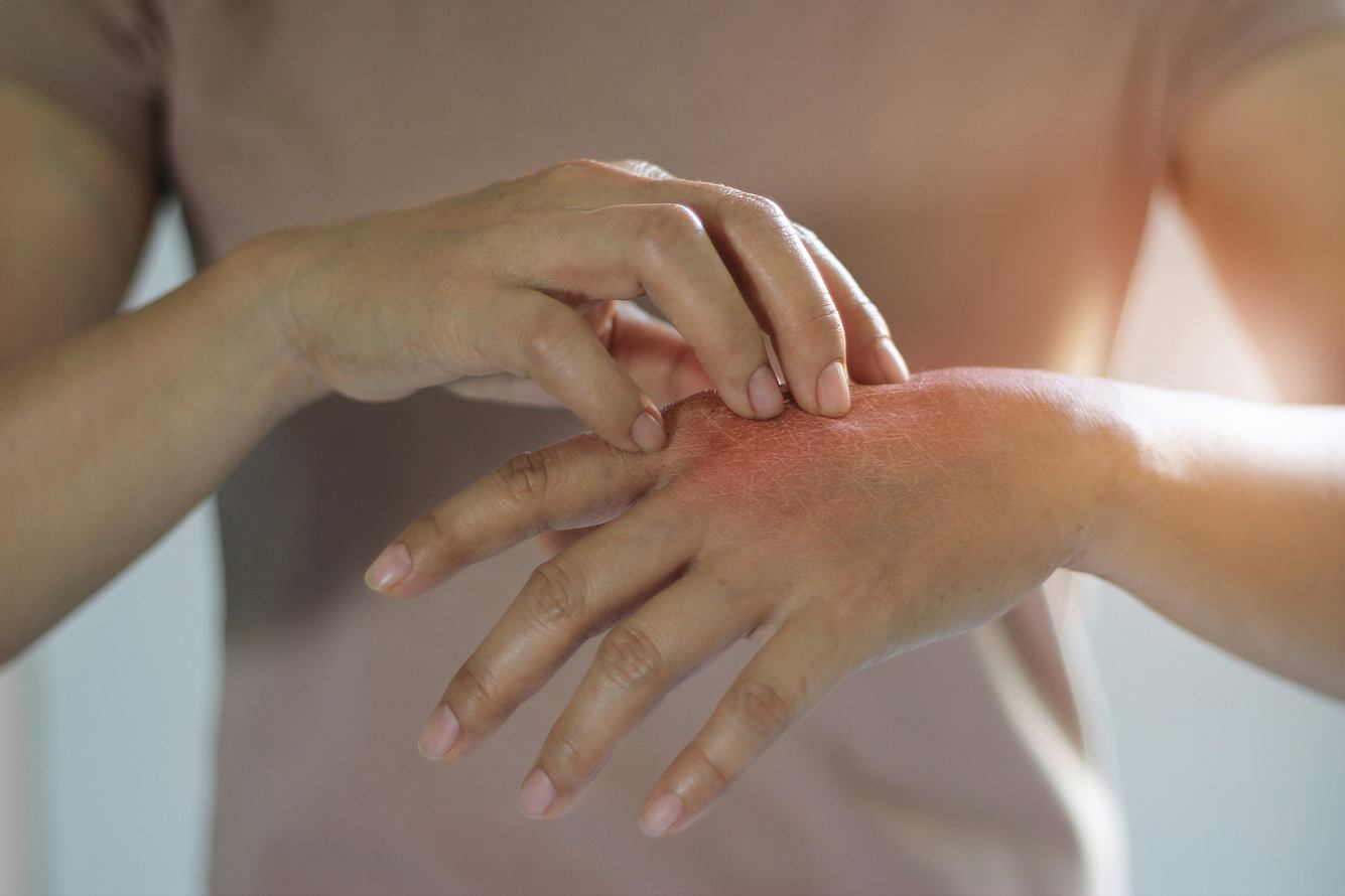 Eine Person kratzt sich an einer roten Stelle auf der Hand.