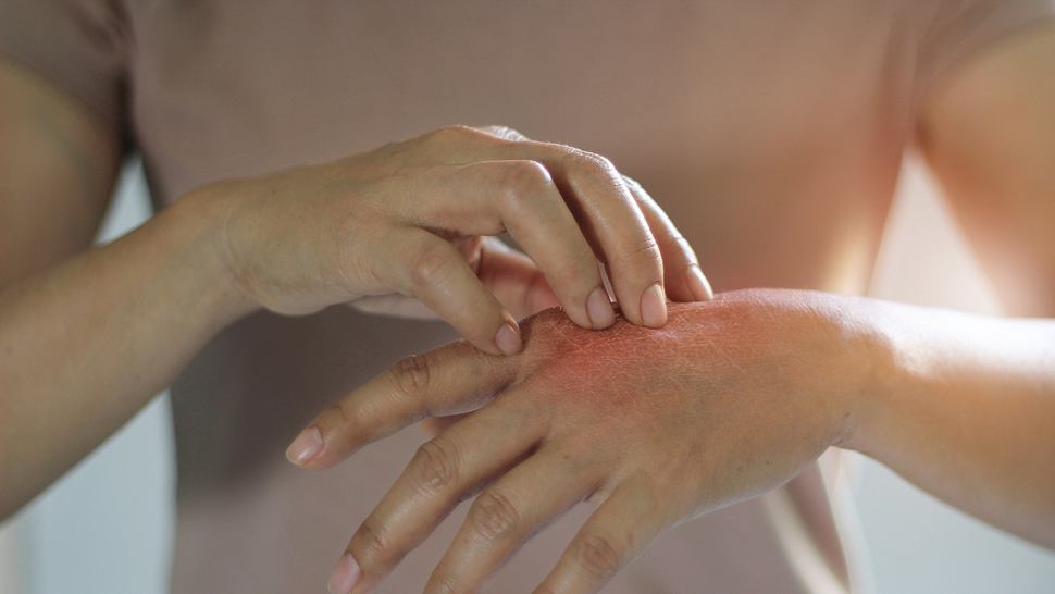 Eine Person kratzt sich an einer roten Stelle auf der Hand. - Foto: iStock/ipopba