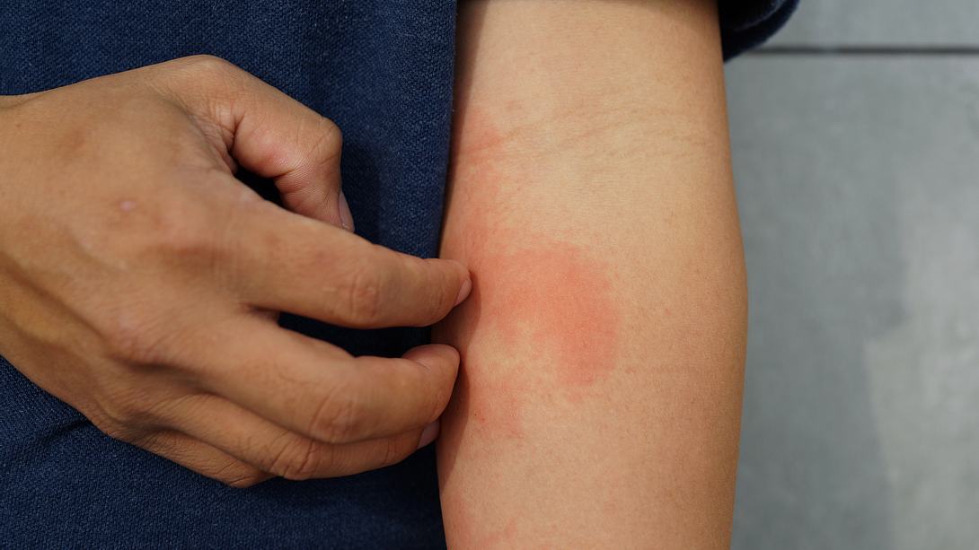Mann mit Ausschlag in der Armbeuge kratzt sich - Foto: iStock/tylim 