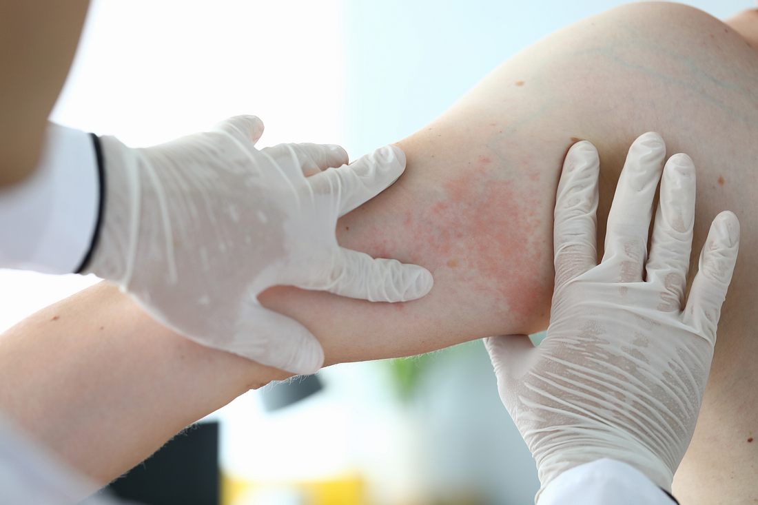 Hautausschlag am Arm Hautausschlag am Arm
