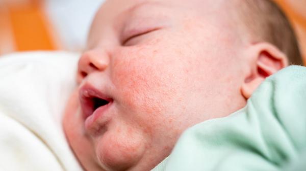 Schlafendes Baby mit Ausschlag im Gesicht - Foto: iStock/Media Trading Ltd