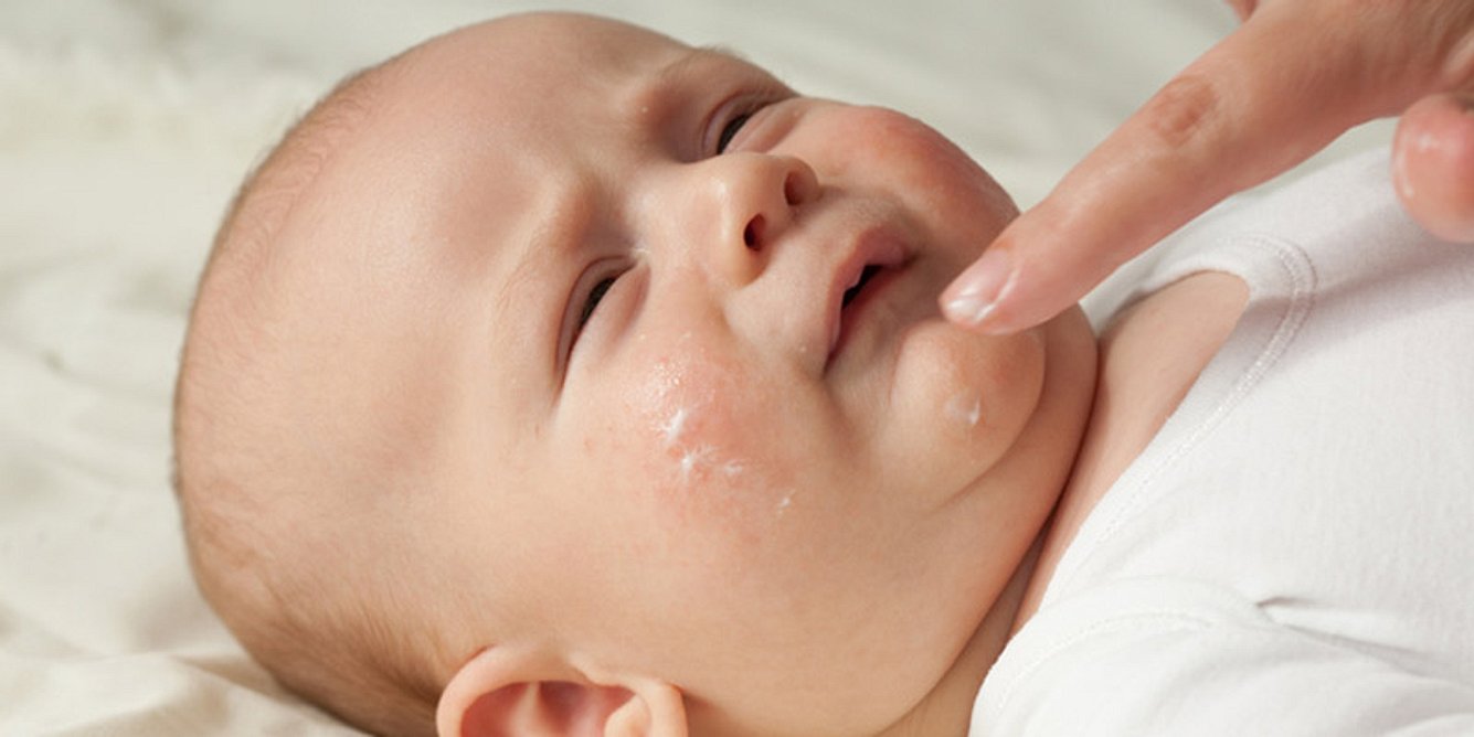Hautkrankheiten können Babys belasten