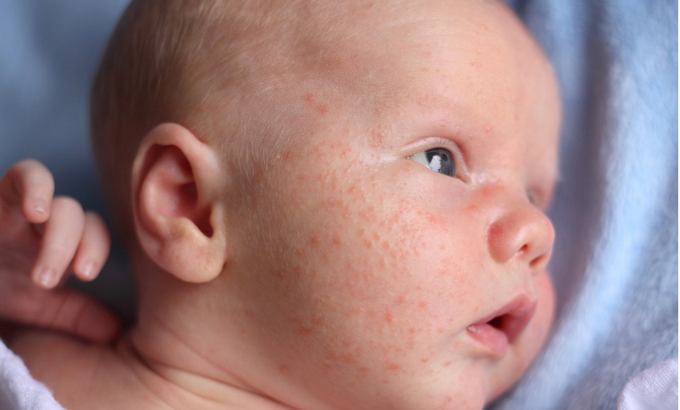 Ein Baby mit Akne im Gesicht
