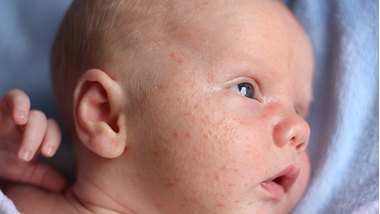 Ein Baby mit Akne im Gesicht - Foto: istock_princessdlaf