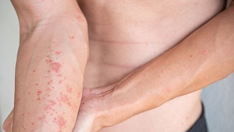 Badedermatitis auf dem Unterarm eines Mannes - Foto: iStock/primeimages