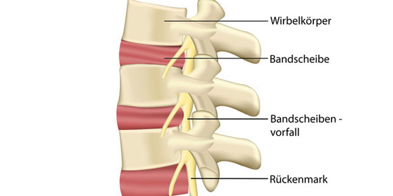 Probleme mit der Bandscheibe können Ursache von Rückenschmerzen