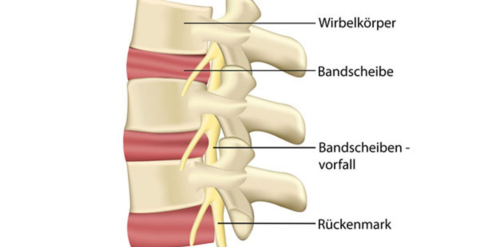 Was ist ein Bandscheibenvorfall? Alle Infos auf Praxisvita.de | PraxisVITA