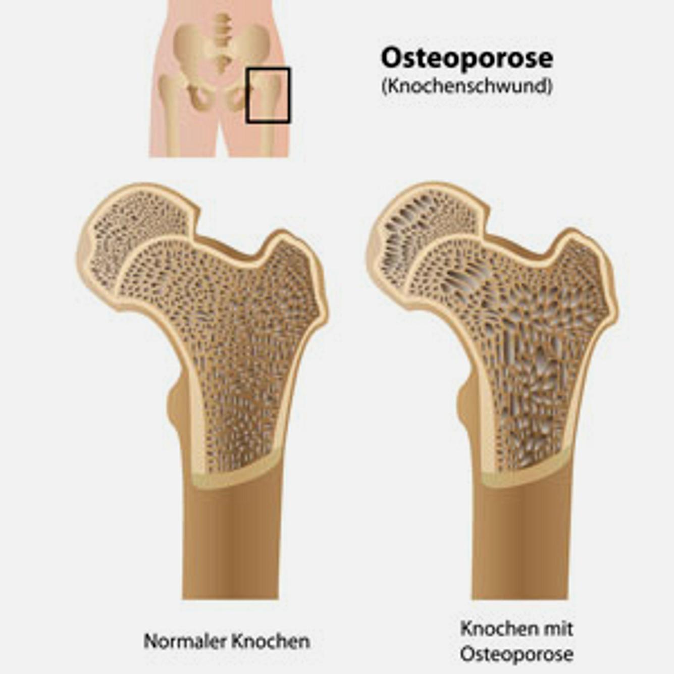 Bei Osteoporose nimmt die Knochendichte ab