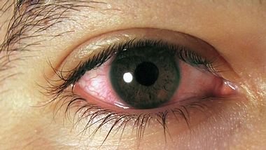 Bindehautentzündung – Augen sind Spiegel der Gesundheit