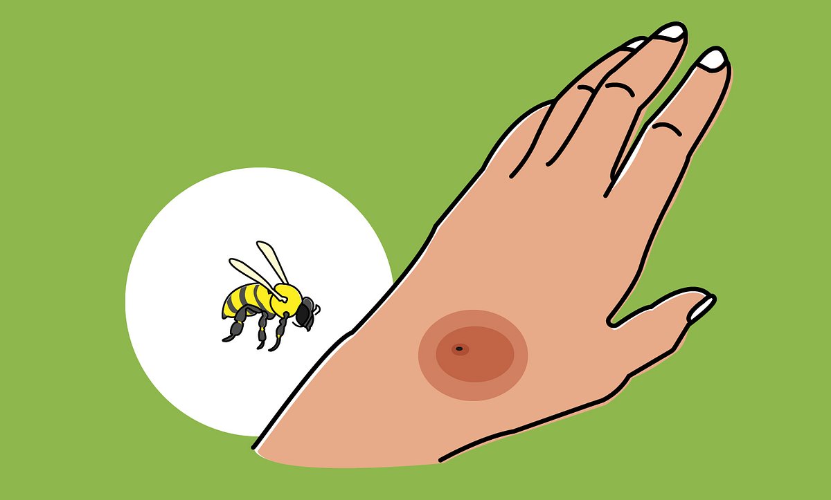 Bienenstiche erkennt man an dem zurückbleibenden Stachel