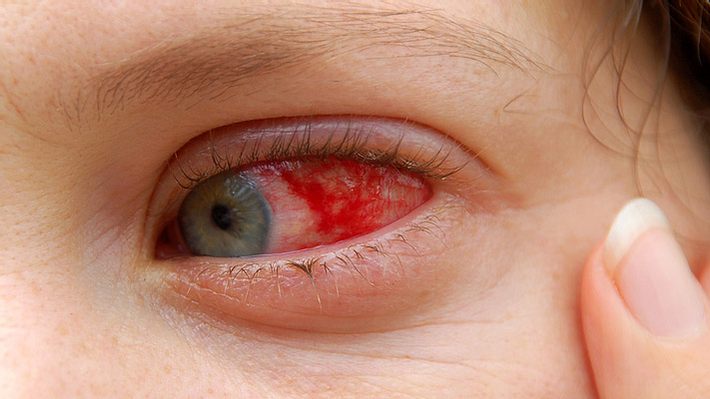 Bindehautentzündung-Symptome sind rote, brennende Augen