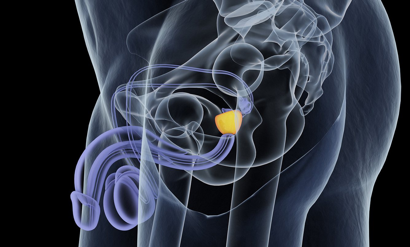 Blasenentzündung Prostata