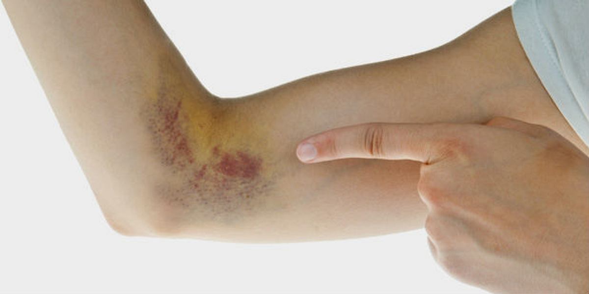 Bei dem „Von-Willebrand-Syndrom“ handelt es sich um eine erblich bedingte Blutgerinnungsstörung.