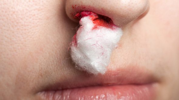 Blutet die Nase häufig, könnte eine erblich bedingte Blutgerinnungsstörung der Grund sein - Foto: shutterstock
