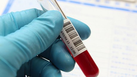 Ein Mediziner hält eine Blutprobe in der Hand - Foto: Fotolia