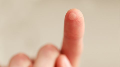 Eine Nahaufnahme einer Brandblase auf einem Finger - Foto: iStock_tomazl