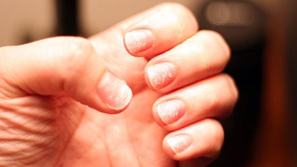 Nagelverfärbungen und brüchige Fingernägel - Foto: Stephan Floss für WDW
