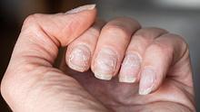 Eine Hand mit brüchigen Fingernägeln.  - Foto: iStock / Alena Ivochkina 
