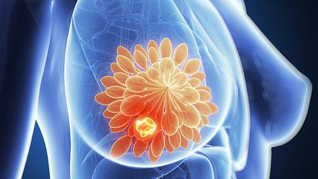 3D-Bild von einer Brust mit Tumor - Foto: iStock/SciePro