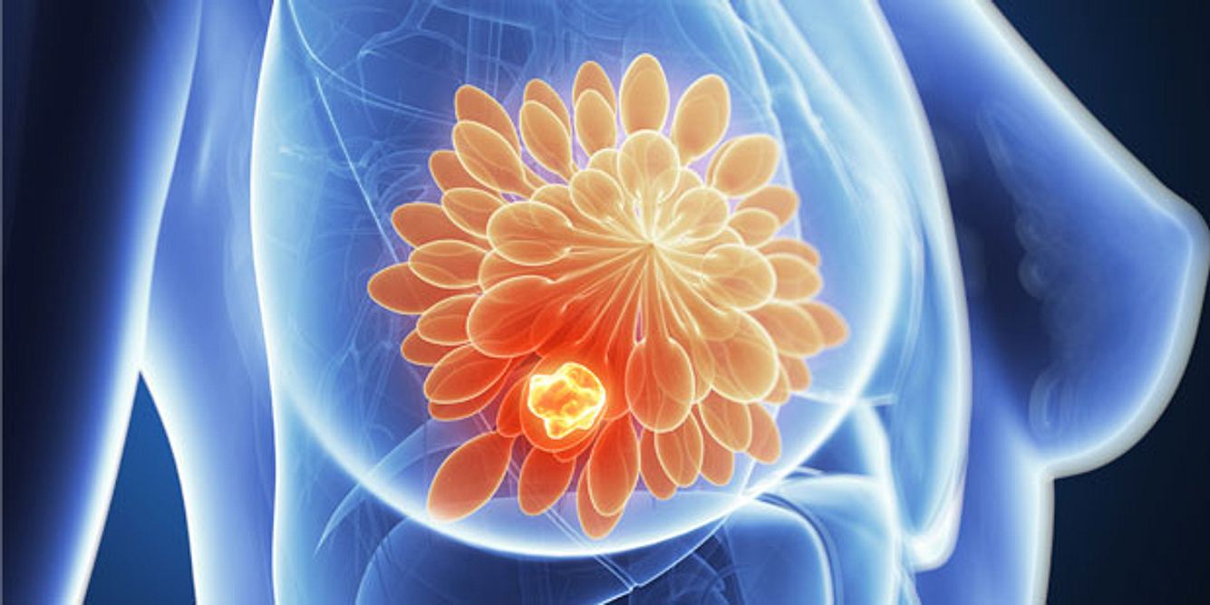 Brustkrebs ist die häufigste Krebserkrankung bei Frauen. Rechtzeitig erkannt und angemessen behandelt, sind die Heilungschancen gut