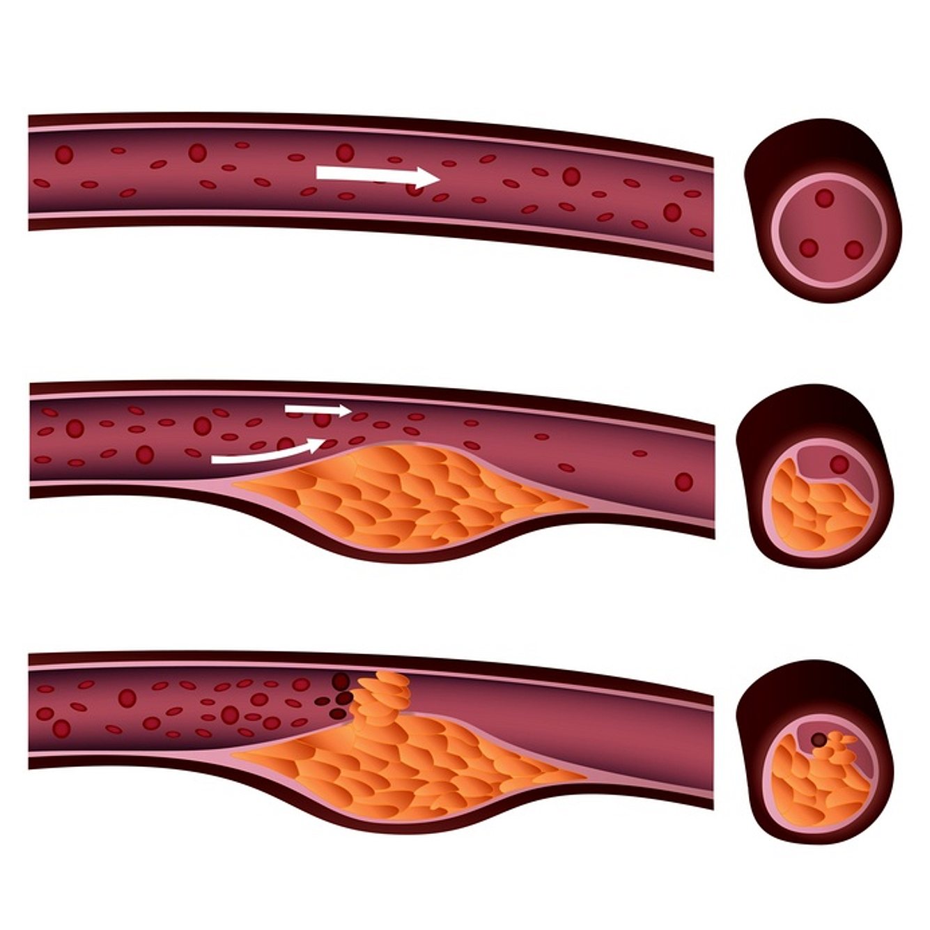 Zu hohe Cholesterin-Spiegel können zu Gefäßverkalkung führen