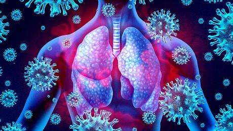 Coronaviren können gefährliche Schädigungen der Lunge verursachen. - Foto: iStock/wildpixel