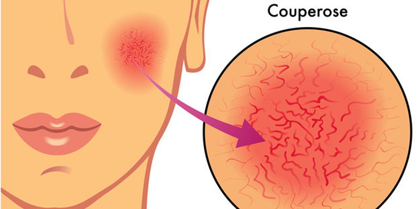 Couperose