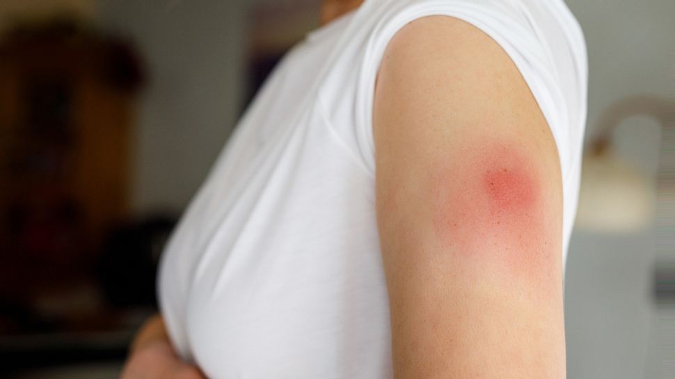 Frau mit Impfreaktion am Arm - Foto: iStock/romrodinka